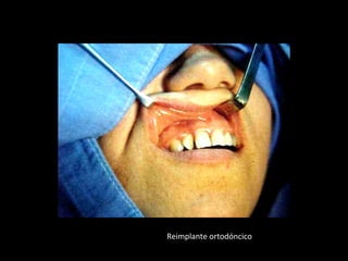 Reimplante ortodóncico
 