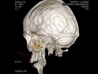Implante en posición
 