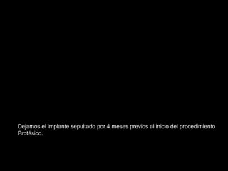 Dejamos el implante sepultado por 4 meses previos al inicio del procedimiento
Protésico.
 