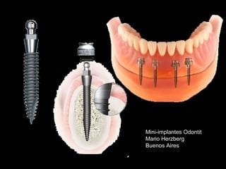 Mini-implantes Odontit
Mario Herzberg
Buenos Aires
 