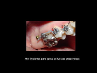 Mini-implantes para apoyo de fuerzas ortodóncicas
 