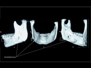 Ameloblastoma
 