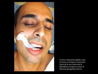 Trismus importante debido a queTrismus importante debido a que
El tumor ya rompió el hueso com-El tumor ya rompió el hueso com-
Pacto de la cara interna de laPacto de la cara interna de la
Mandíbula y empezó a tomar elMandíbula y empezó a tomar el
Músculo pterigoideo interno.Músculo pterigoideo interno.
 