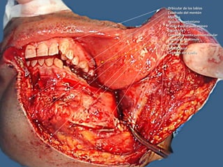 Orbicular de los labiosOrbicular de los labios
Cuadrado del mentónCuadrado del mentón
MentónMentón
Agujero mentonianoAgujero mentoniano
Tejido celular subcutáneoTejido celular subcutáneo
DigástricoDigástrico
Compartimiento submandibularCompartimiento submandibular
Conducto de StenonConducto de Stenon
Arteria facialArteria facial
Nervio facialNervio facial
Cutáneo del cuelloCutáneo del cuello
 