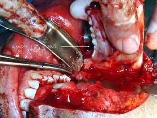Luxación de hemimandíbulaLuxación de hemimandíbula
 