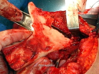 Pieza quirúrgicaPieza quirúrgica
 