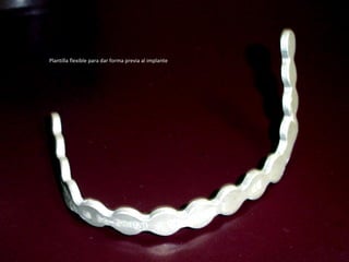 Plantilla flexible para dar forma previa al implante
 