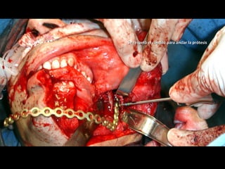 Se respetó el cóndilo para anclar la prótesisSe respetó el cóndilo para anclar la prótesis
 