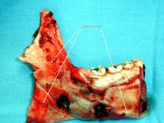 Límite tumoralLímite tumoral
 