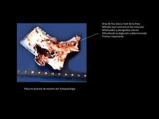 Area de lisis ósea a nivel de la líneaArea de lisis ósea a nivel de la línea
Miliodes que contracturó los músculosMiliodes que contracturó los músculos
Milohioideo y pterigoideo internoMilohioideo y pterigoideo interno
Dificultando la deglución y determinandoDificultando la deglución y determinando
Trismus importante.Trismus importante.
Pieza en proceso de examen por histopatologíaPieza en proceso de examen por histopatología
 