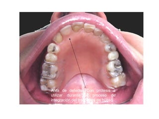 Area de defecto. Con prótesis a
utilizar durante el proceso de
integración del trasplante de hueso
 