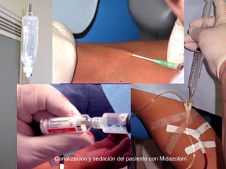 Canalización y sedación del paciente con Midazolam
 