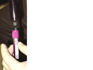 La sangre se vierte en tubo de ensayo con
anticoagulante a base de citrato.
 