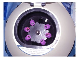 Centrifugación de la sangre por el protocolo de Anitua
 