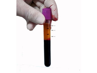 Sangre centrifugada con plasma en parte superior
Fracción I – PPP
Fracción II – Plasma equiplaquetario
Fracción II – PRP o PRGF
 