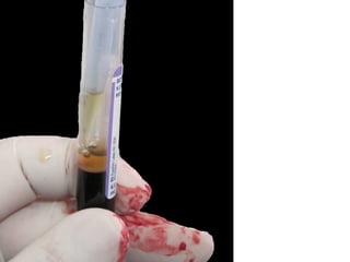 Pipeteo meticuloso de la
fracción III, si se
contamina con fórmula
roja habrá de
deshecharse y cambiar
de pipeta
 