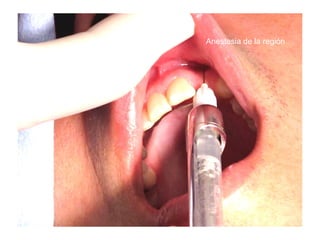 Anestesia de la región
 
