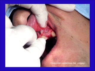 Disección cuidadosa del colgajo
 