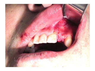 Defecto óseo a corregir
 