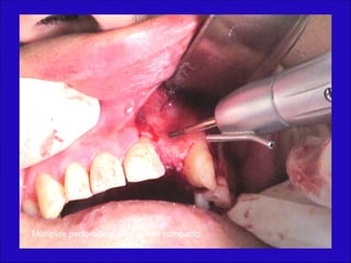 Múltiples perforaciones en hueso compacto
 