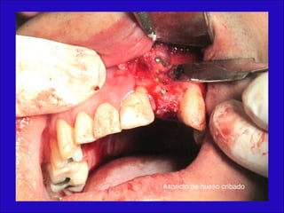 Aspecto de hueso cribado
 