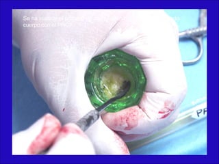 Se ha iniciado el proceso de coagulación con el hueso formando
cuerpo con el PRGF.
 