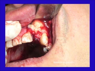 Material en posición
 