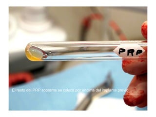 El resto del PRP sobrante se coloca por encima del implante previo
 