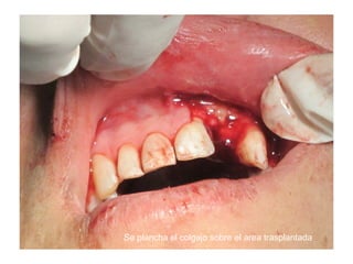 Se plancha el colgajo sobre el area trasplantada
 