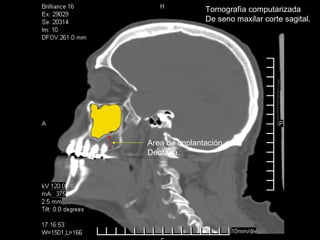 Tomografía computarizada
De seno maxilar corte sagital.
Area de implantación
Dentaria.
 