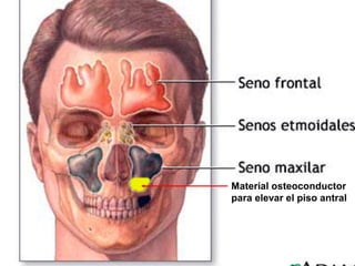 Material osteoconductor
para elevar el piso antral
 