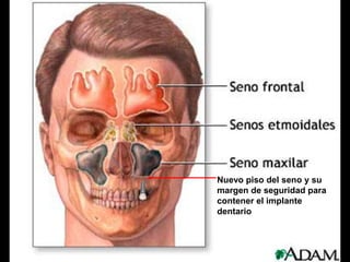 Nuevo piso del seno y su
margen de seguridad para
contener el implante
dentario
 