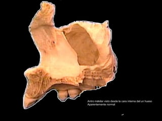 Antro maxilar visto desde la cara interna del un hueso
Aparentemente normal
 
