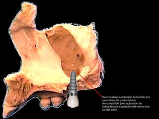 Seno maxilar aumentado de tamaño por
neumatización y edentulosis.
No compatible para aplicación de
implantes por exposición del mismo a la
luz del antro.
 