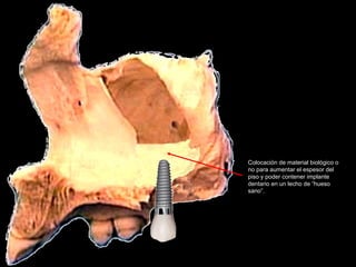 Colocación de material biológico o
no para aumentar el espesor del
piso y poder contener implante
dentario en un lecho de “hueso
sano”.
 