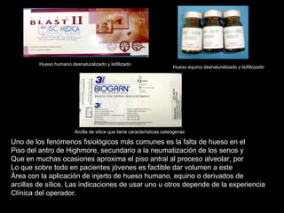 Uno de los fenómenos fisiológicos más comunes es la falta de hueso en el
Piso del antro de Highmore, secundario a la neumatización de los senos y
Que en muchas ocasiones aproxima el piso antral al proceso alveolar, por
Lo que sobre todo en pacientes jóvenes es factible dar volumen a este
Área con la aplicación de injerto de hueso humano, equino o derivados de
arcillas de sílice. Las indicaciones de usar uno u otros depende de la experiencia
Clínica del operador.
Hueso humano desnaturalizado y liofilizado
Hueso equino desnaturalizado y liofiliozado
Arcilla de sílice que tiene características osteógenas
 