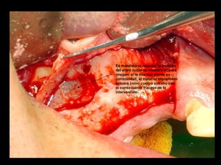 Es mandatorio respetar la mucosa
del antro como se muestra en esta
imagen, si la mucosa pierde su
continuidad, él material implantado
actuará como cuerpo extraño con
el consecuente fracaso de la
intervención.
 