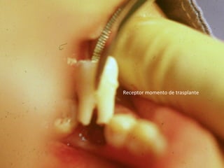 Receptor momento de trasplante
 