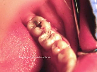 Trasplante 3 meses de evolución
 