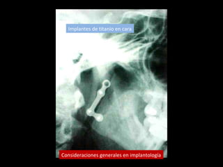 Implantes de titanio en cara
Consideraciones generales en implantología
 
