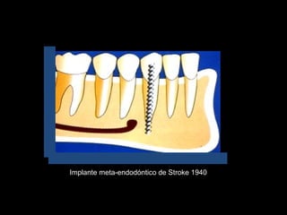 Implante meta-endodóntico de Stroke 1940
 