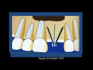 Agujas de Scialóm 1970
 