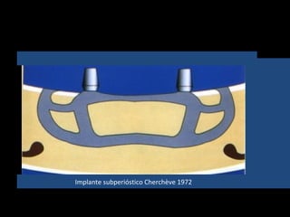 Implante subperióstico Cherchève 1972
 
