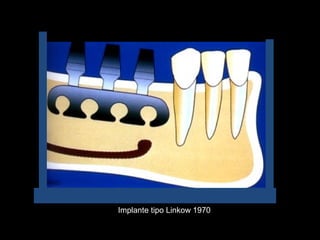 Implante tipo Linkow 1970
 