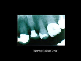 Implantes de carbón vítreo
 