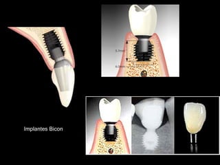 Implantes Bicon
 