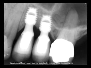 Implantes Bicon, con menor longitud y mayor area de contacto
 