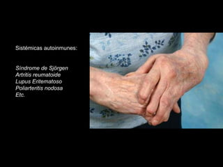Sistémicas autoinmunes:
Síndrome de Sjörgen
Artritis reumatoide
Lupus Eritematoso
Poliarteritis nodosa
Etc.
 