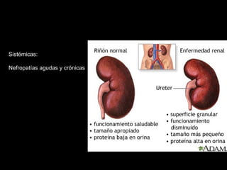 Sistémicas:
Nefropatías agudas y crónicas
 