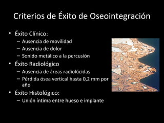 Criterios de Éxito de Oseointegración
• Éxito Clínico:
– Ausencia de movilidad
– Ausencia de dolor
– Sonido metálico a la percusión
• Éxito Radiológico
– Ausencia de áreas radiolúcidas
– Pérdida ósea vertical hasta 0,2 mm por
año
• Éxito Histológico:
– Unión íntima entre hueso e implante
 